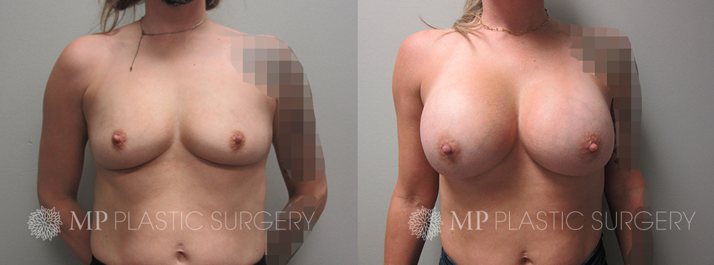 Fort Worth Breast Augmentation Patient 10 Front