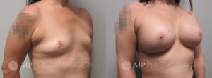 Fort Worth Breast Augmentation Patient 11 Oblique 2