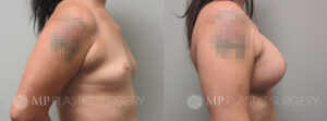 Fort Worth Breast Augmentation Patient 11 Side 2