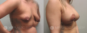 Fort Worth Breast Lift Patient 9 Oblique