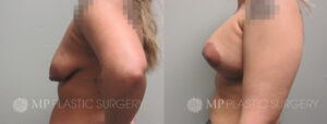 Fort Worth Breast Lift Patient 9 Side 2