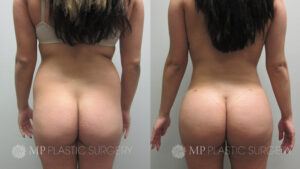 Fort Worth Brazilian Butt Lift Before & After Patient 1 Back