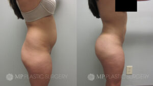 Fort Worth Brazilian Butt Lift Before & After Patient 1 Side