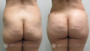 Fort Worth Brazilian Butt Lift Before & After Patient 2 Back