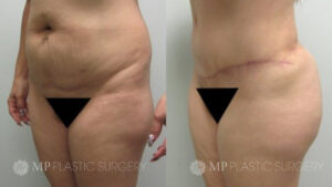Fort Worth Brazilian Butt Lift Before & After Patient 2 Oblique