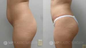 Fort Worth Brazilian Butt Lift Before & After Patient 3 Side 2
