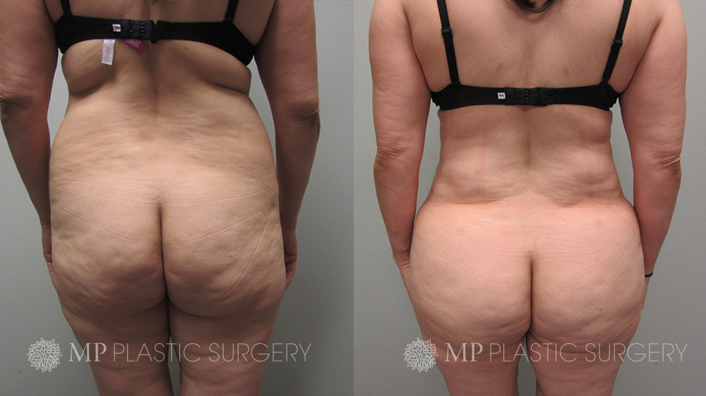 Fort Worth Brazilian Butt Lift Before & After Patient 4 Back