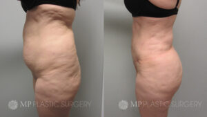 Fort Worth Brazilian Butt Lift Before & After Patient 4 Side 2