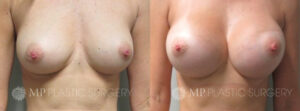 Fort Worth Breast Augmentation Patient 1 Front