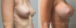 Fort Worth Breast Augmentation Patient 1 Oblique