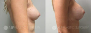 Fort Worth Breast Augmentation Patient 1 Side
