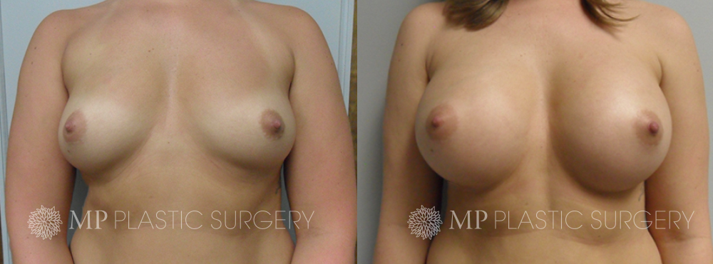 Fort Worth Breast Augmentation Patient 3 Front
