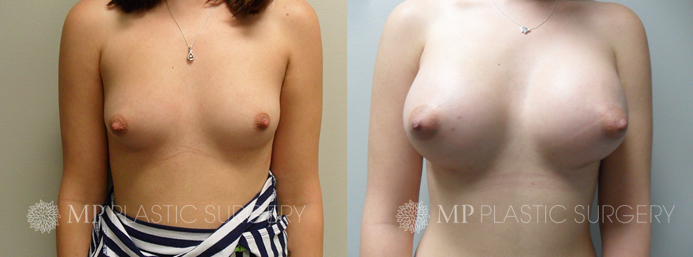 Fort Worth Breast Augmentation Patient 6 Front