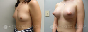 Fort Worth Breast Augmentation Patient 6 Oblique