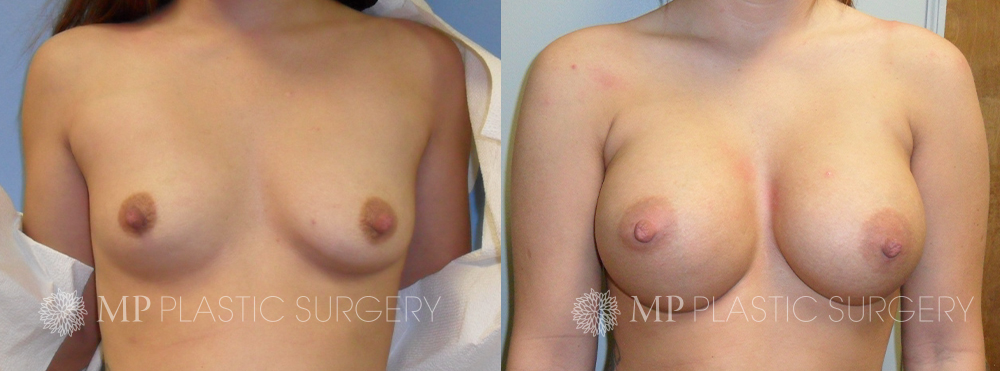 Fort Worth Breast Augmentation Patient 7 Front