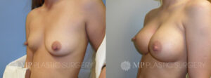 Fort Worth Breast Augmentation Patient 7 Oblique
