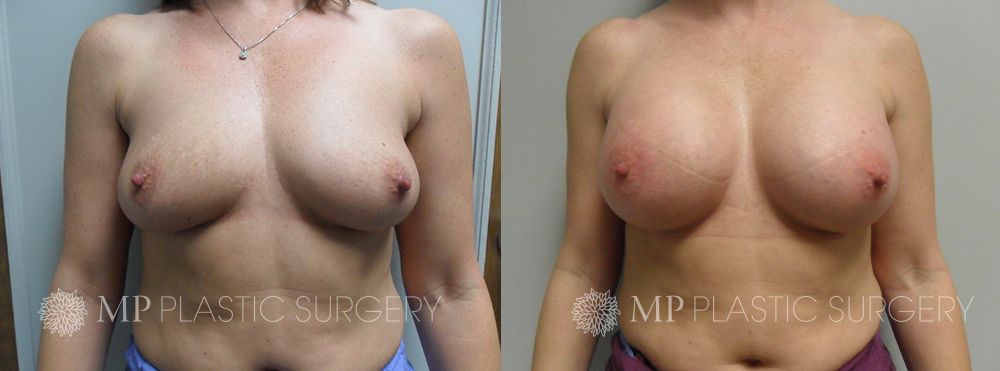 Fort Worth Breast Augmentation Patient 8 Front