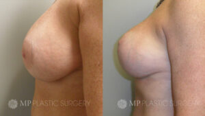 Fort Worth Breast Lift Patient 4 Side