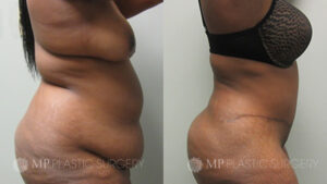 Fort Worth Tummy Tuck Before & After Patient 1 Right Side