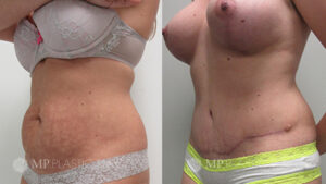 Fort Worth Tummy Tuck Before & After Patient 3 Oblique Right