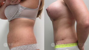 Fort Worth Tummy Tuck Before & After Patient 3 Side Left