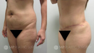 Fort Worth Tummy Tuck Before & After Patient 5 Side Oblique