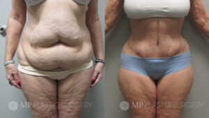 Fort Worth Tummy Tuck Before & After Patient 6 Front