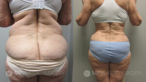 Fort Worth Tummy Tuck Before & After Patient 6 Back