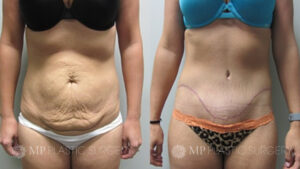 Fort Worth Tummy Tuck Before & After Patient 7 Front