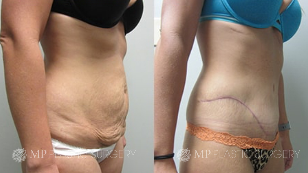 Fort Worth Tummy Tuck Before & After Patient 7 Oblique