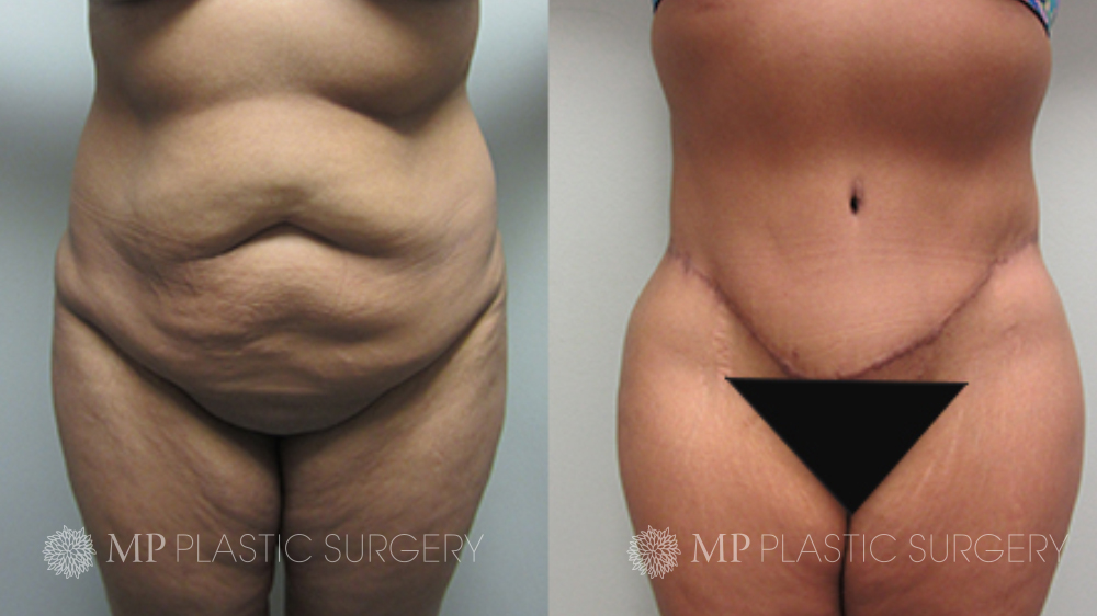 Fort Worth Tummy Tuck Before & After Patient 8 Front