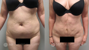 Fort Worth Brazilian Butt Lift Before & After Patient 4 Front