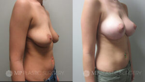 Fort Worth Breast Lift Patient 1 Right Oblique