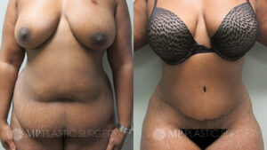 Fort Worth Tummy Tuck Before & After Patient 1 Front