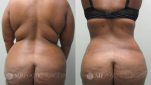 Fort Worth Tummy Tuck Before & After Patient 1 Back