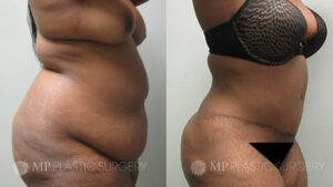 Fort Worth Tummy Tuck Before & After Patient 1 Left Oblique