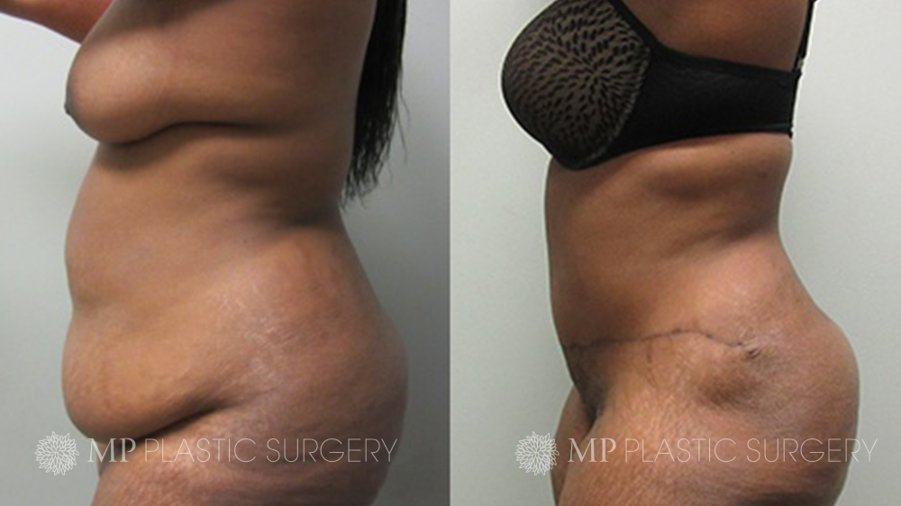 OR Snapshots - Abdominal and Flank Liposuction - Explore Plastic Surgery,  flanks 