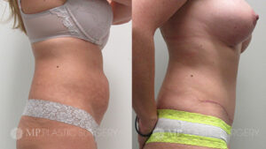 Fort Worth Tummy Tuck Before & After Patient 3 Side