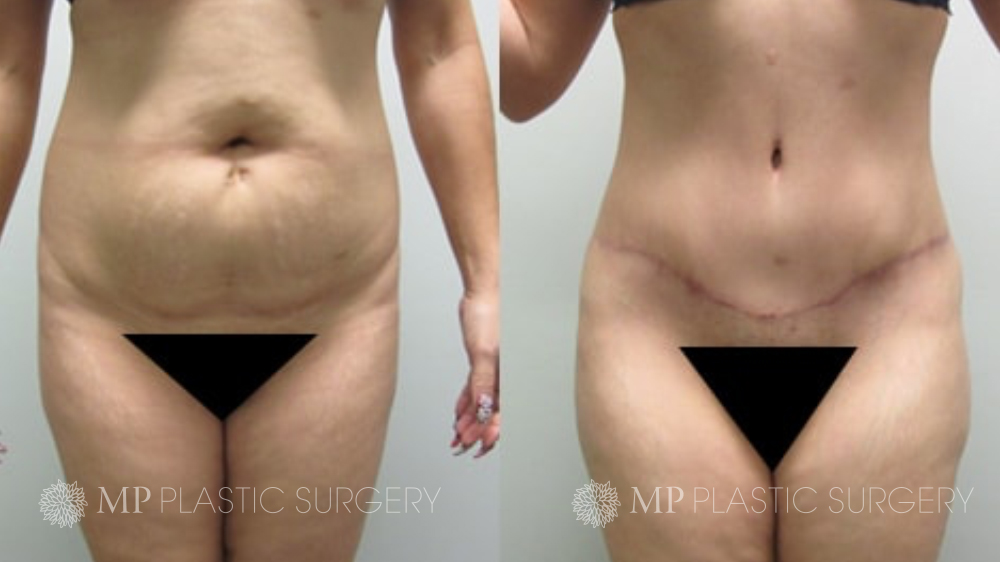 Fort Worth Tummy Tuck Before & After Patient 5 Front