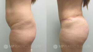 Fort Worth Tummy Tuck Before & After Patient 5 Side