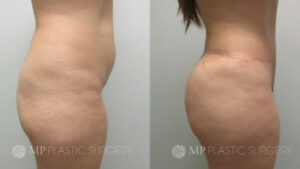 Fort Worth Tummy Tuck Before & After Patient 5 Side Right