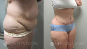 Fort Worth Tummy Tuck Before & After Patient 6 Oblique Right
