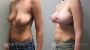 Fort Worth Breast Lift Patient 1 Oblique 1