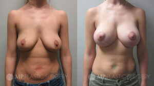 Fort Worth Breast Lift Patient 1 Front 2