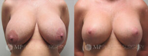 Fort Worth Breast Lift Patient 3 Front 1